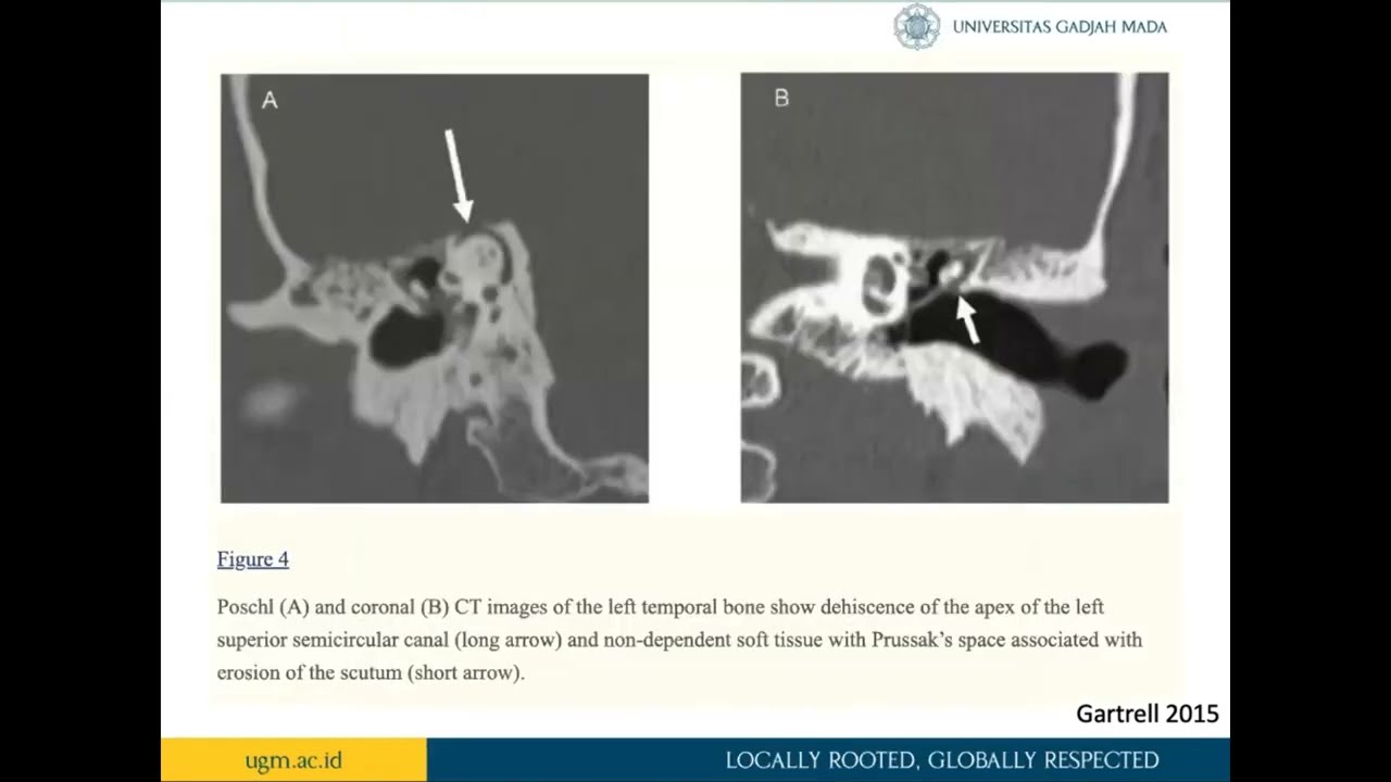 Computed Tomography Imaging of the Facial Nerve Course and its Variations