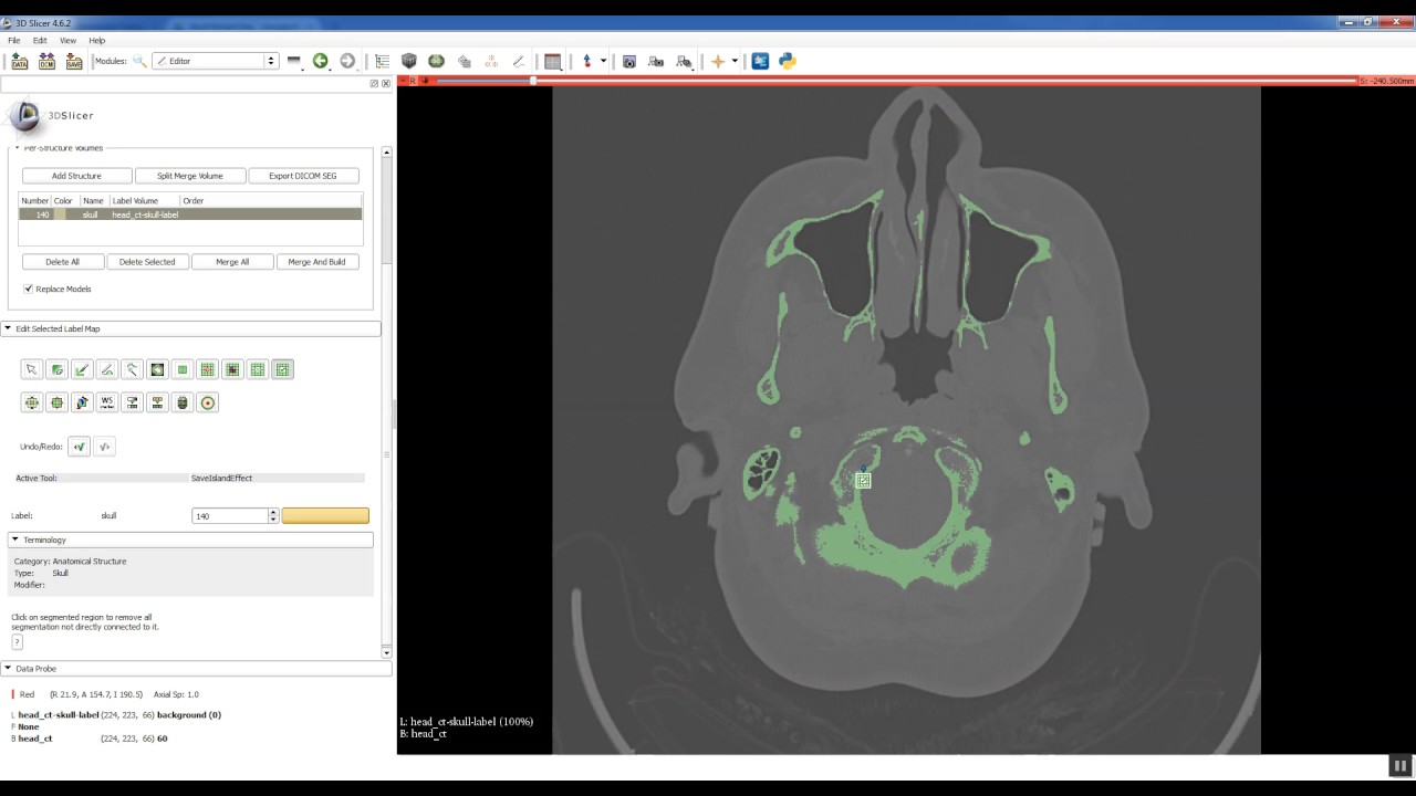 Step 1   Segment CT in Slicer