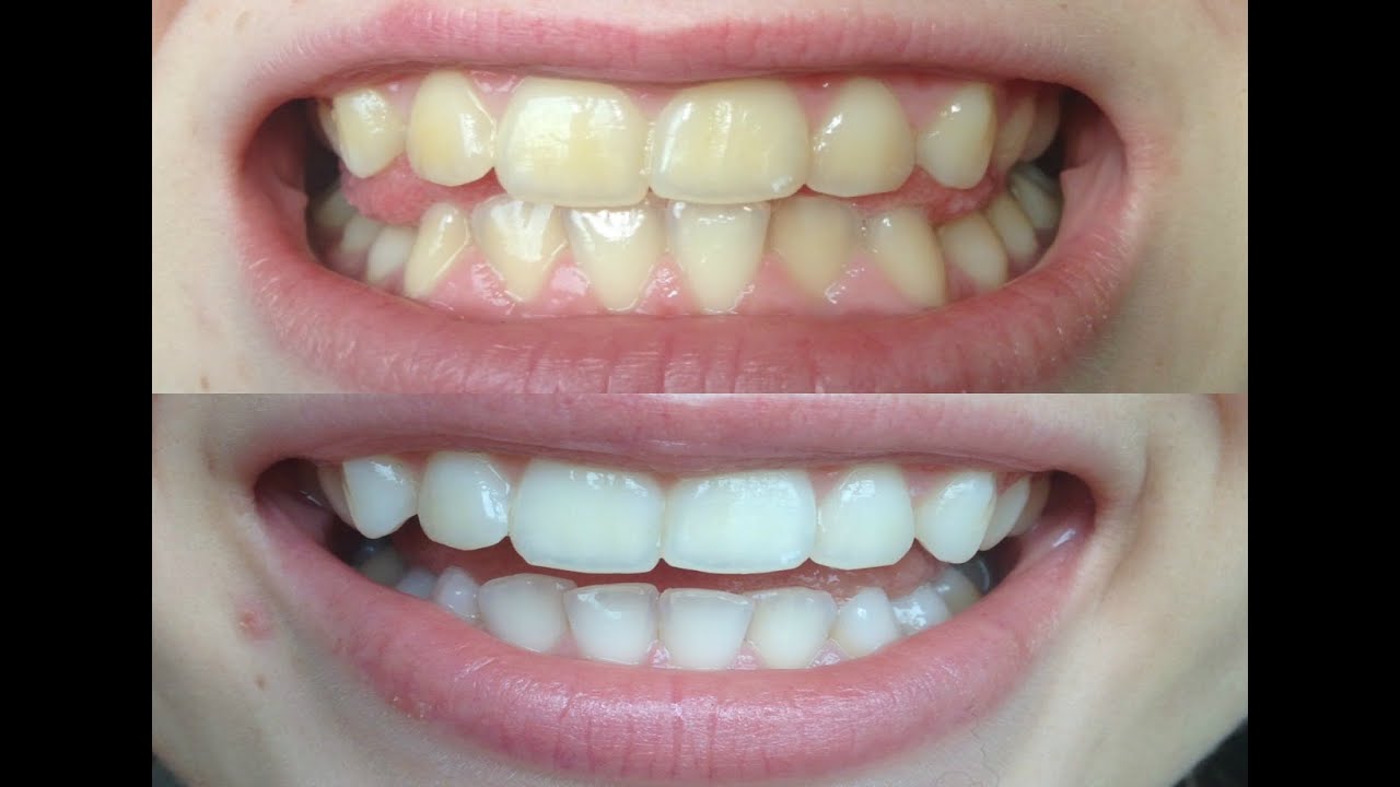 How I whitened my VERY yellow teeth! (WORKS!) BEFORE AND AFTER!