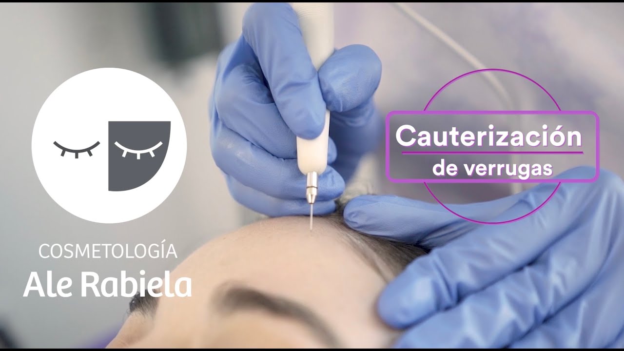 ¿Cómo se eliminan las verrugas? 😱
