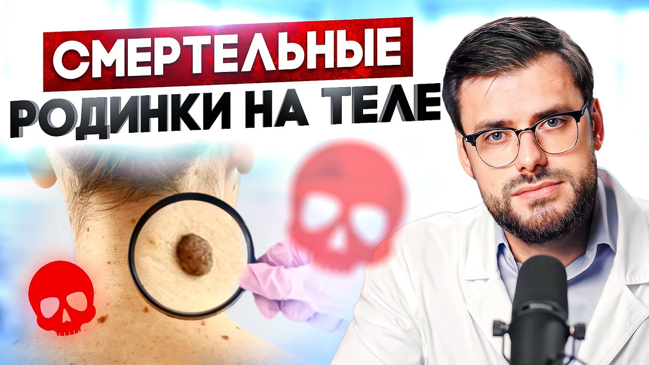 ОПАСНЫЕ РОДИНКИ: как распознать родинку вызывающую РАК?