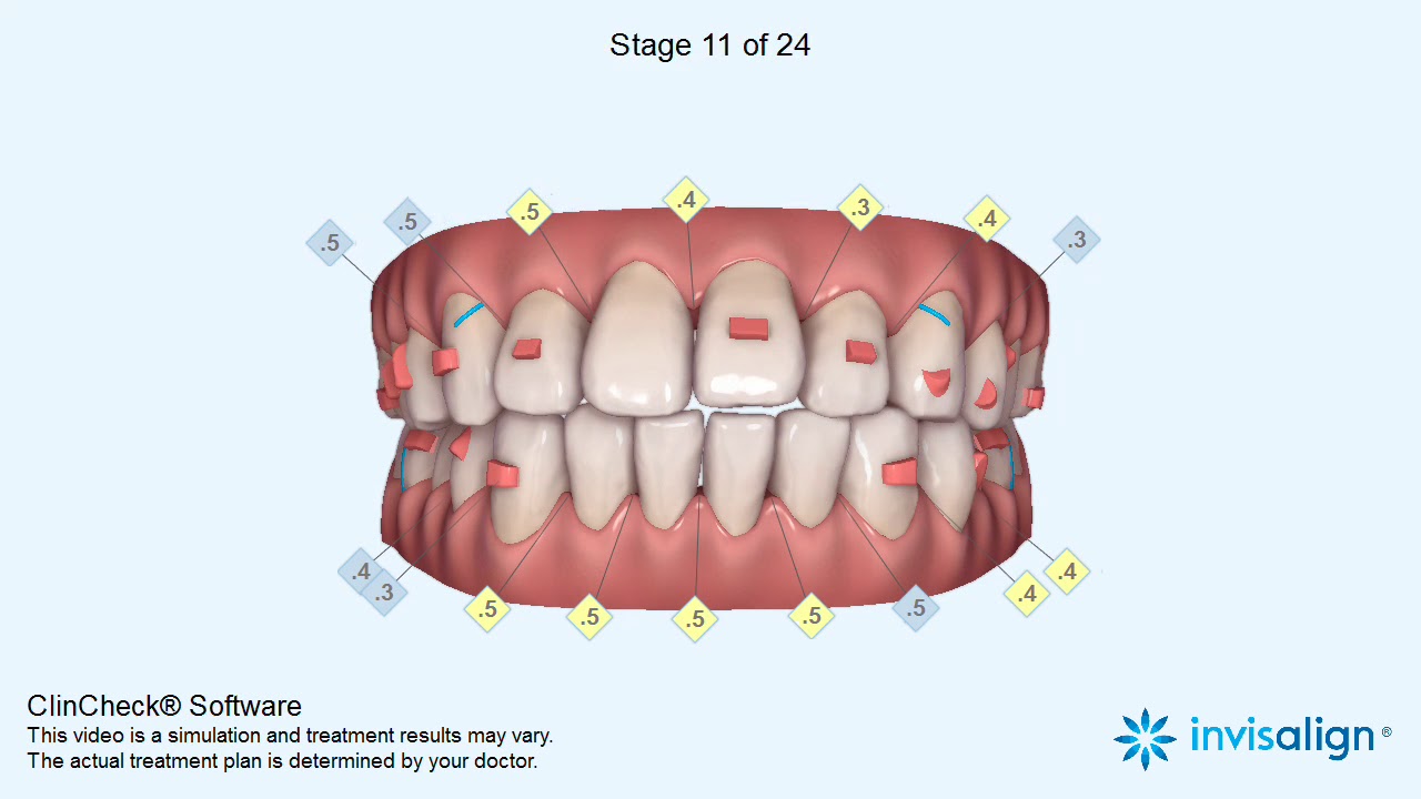 Invisalign ClinCheck&reg;