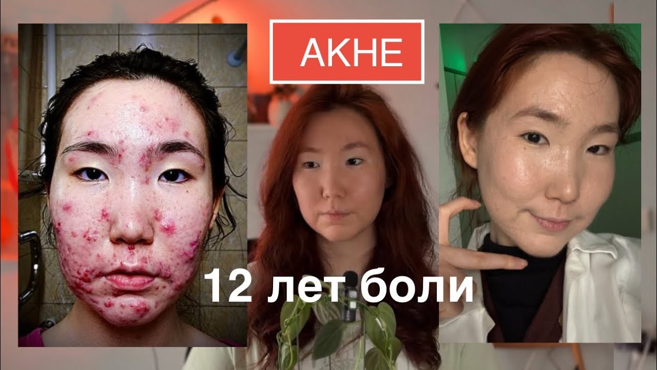 Моя история акне: 12 лет боли