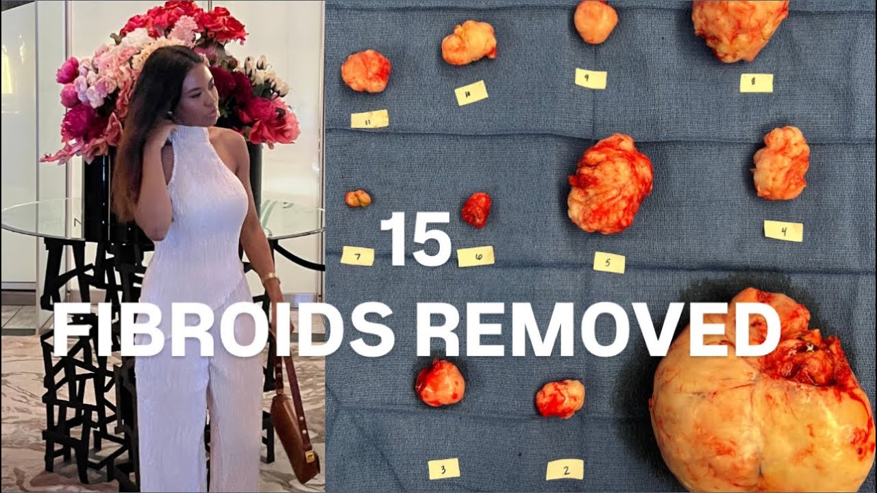 My fibroid story update: Open Myomectomy surgery 2024