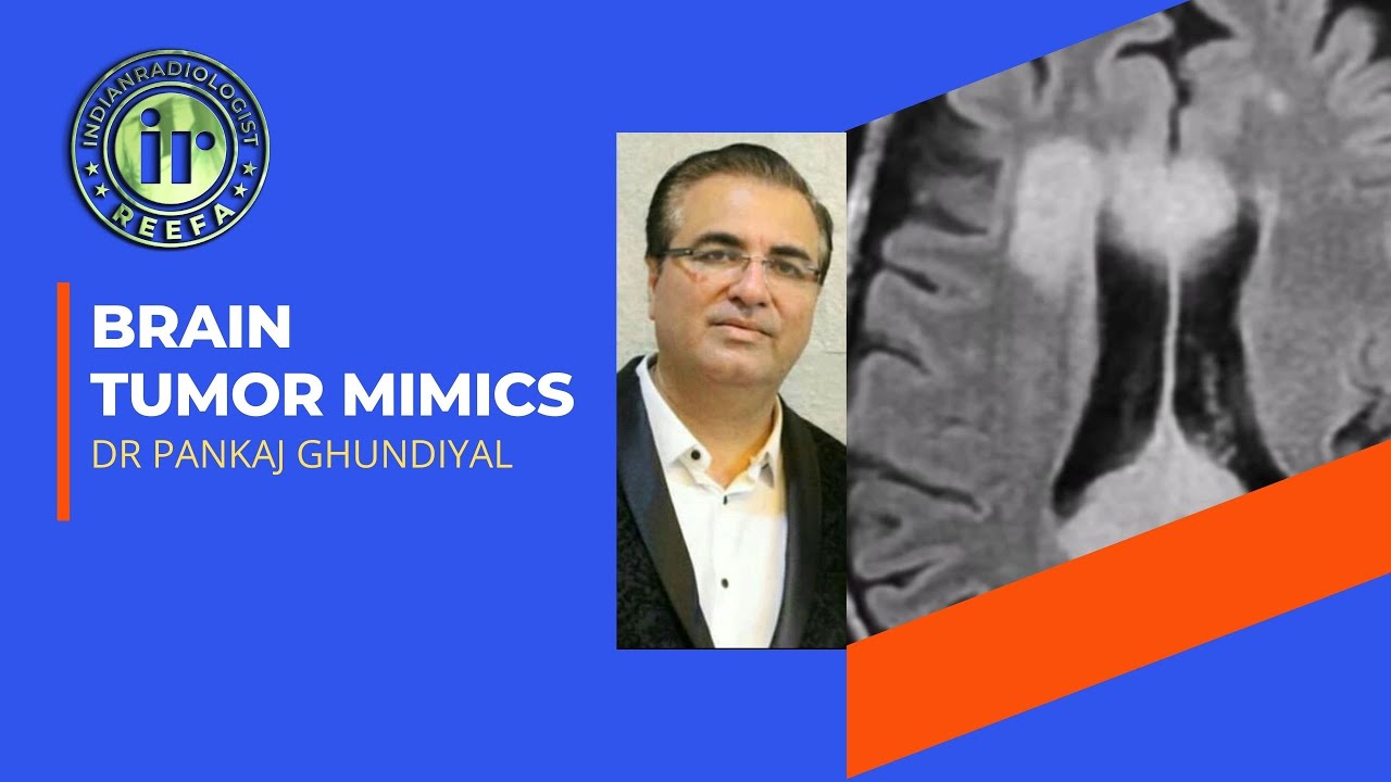 TUMOR MIMICS IN BRAIN | CASE BASED REVIEW | PANKAJ GHUNDIYAL | DEMYELINATION | INFECTIONS | ANEURYSM