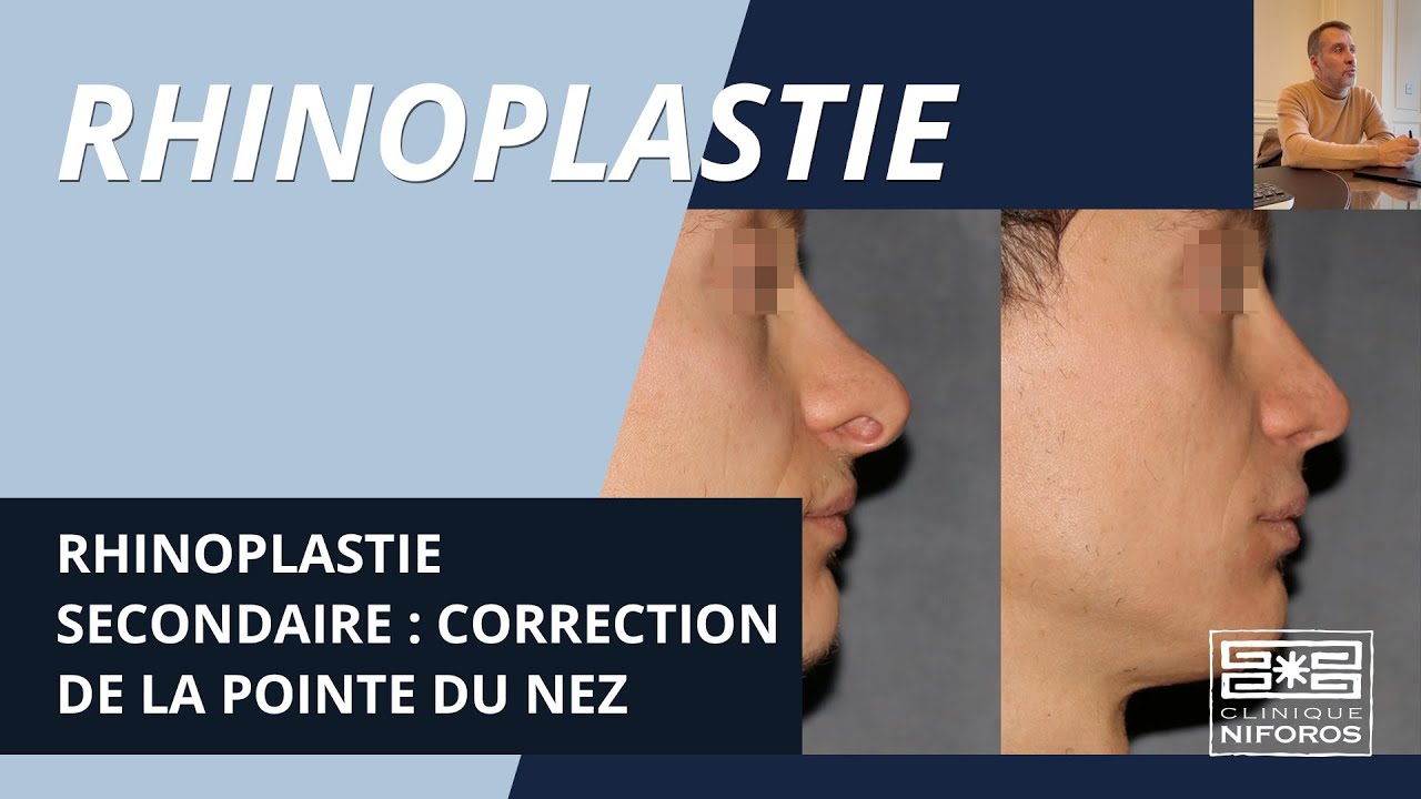 Rhinoplastie secondaire pour corriger la pointe du nez - Dr Niforos à Lyon