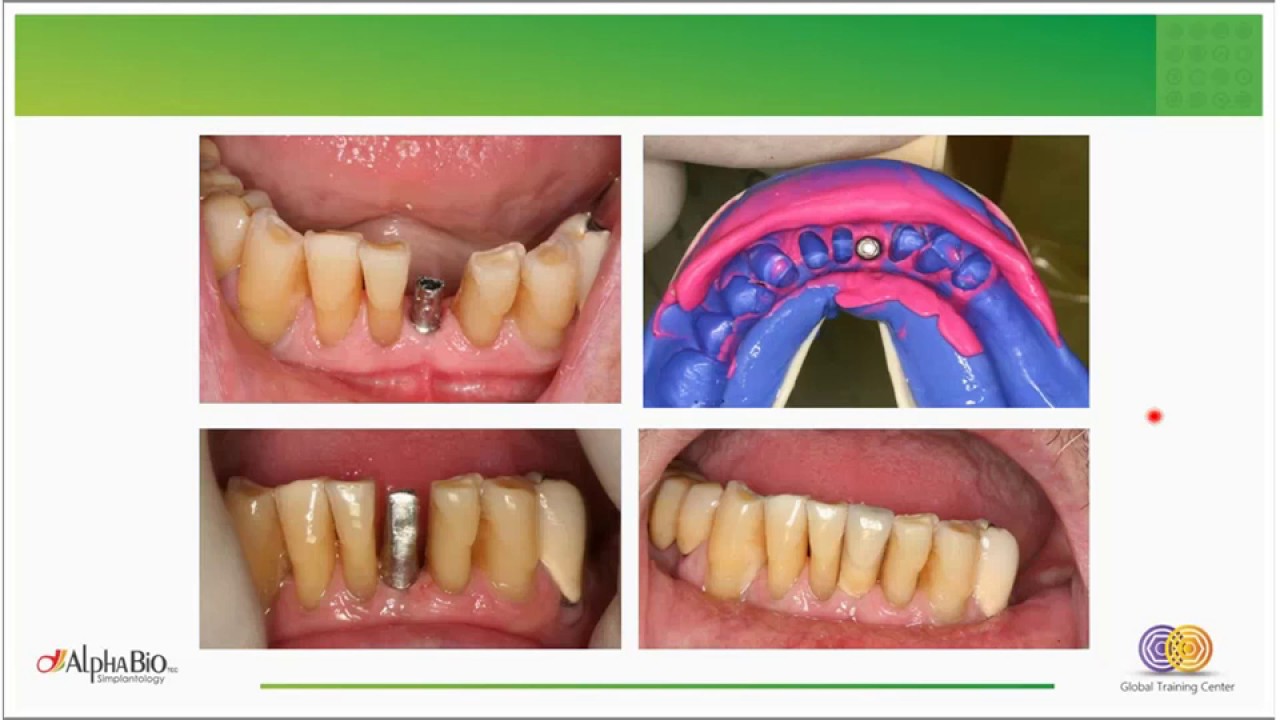 Clinical aspects of abutment selection and connection (recorded webinar)  | Alpha-Bio Tec