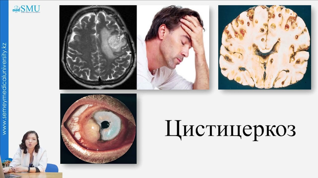 Цестодозы