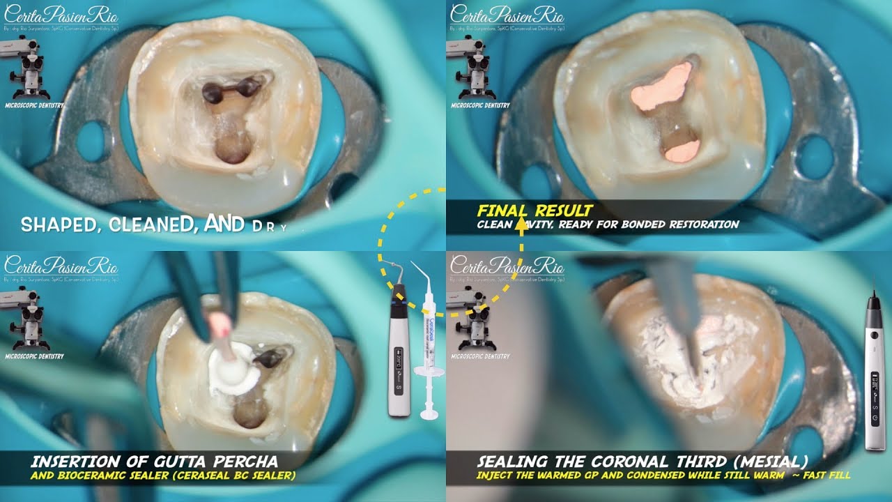 hydraulic condensation bioceramic bc sealer ceraseal continuous wave endodontic obturation eighteeth