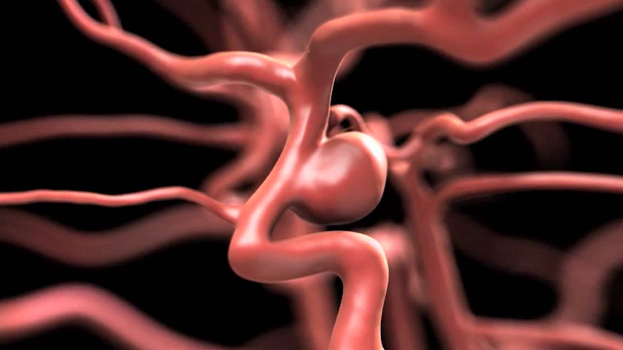 Using Pipeline® To Repair A Brain Aneurysm Without Surgery