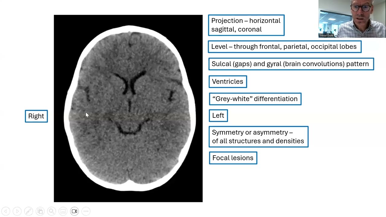 2024 21 Head CT interpretation in children