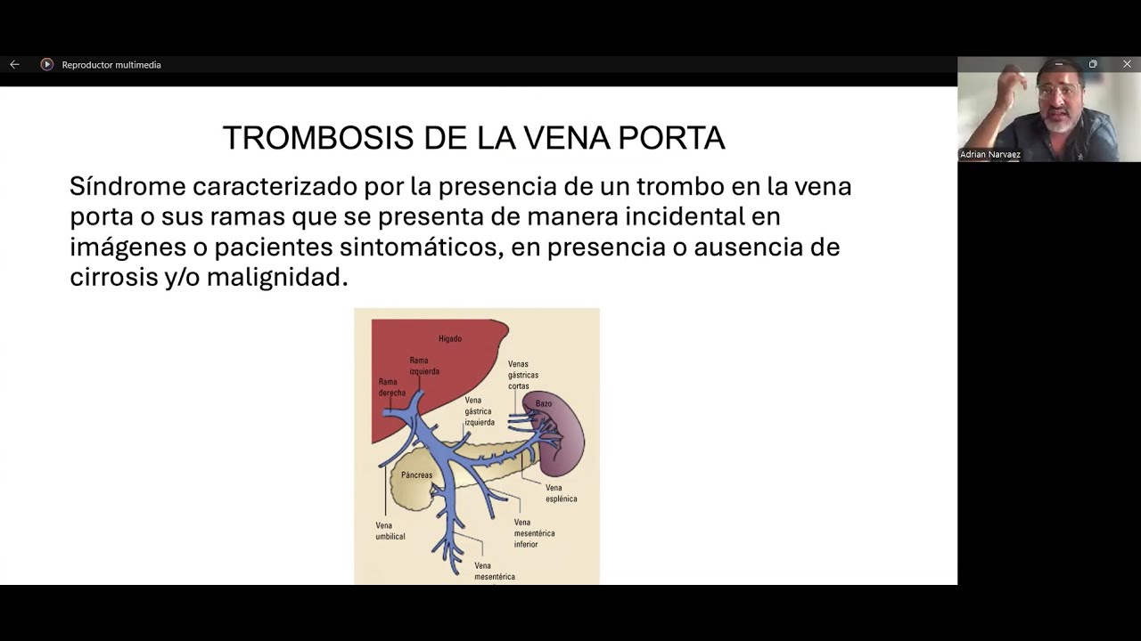 Trombosis portal: diagnóstico y tratamiento