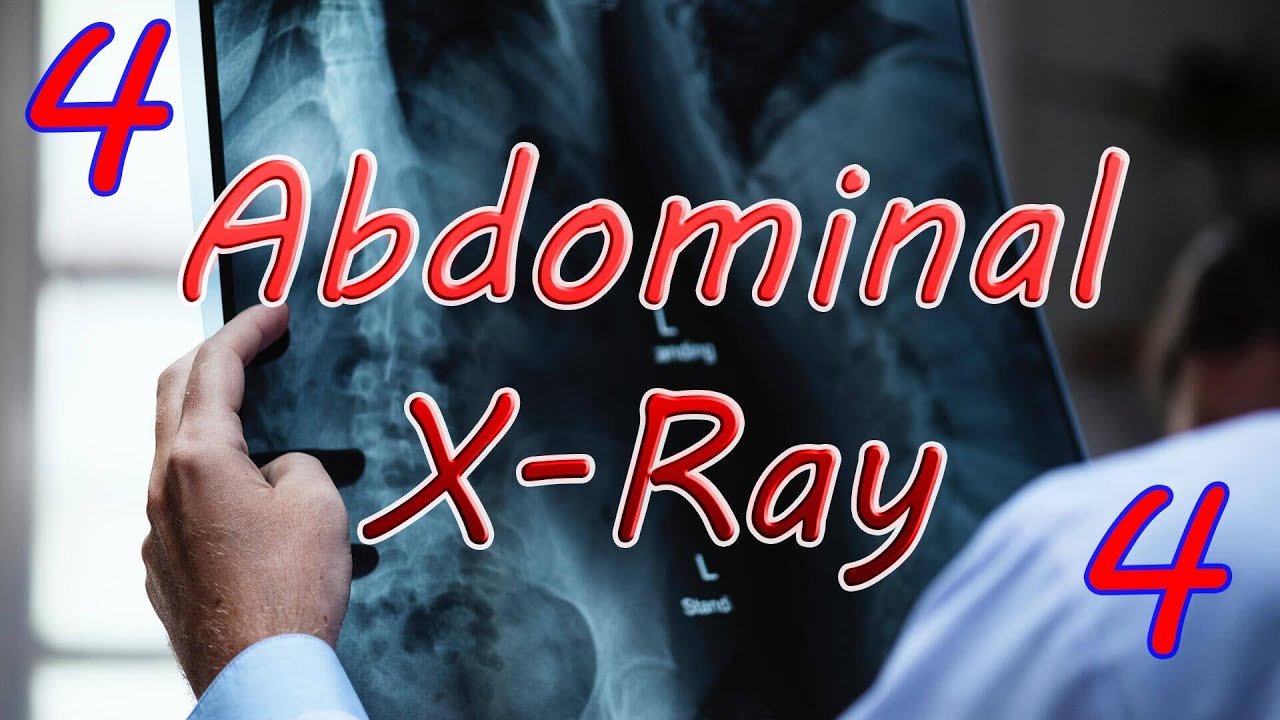 Large bowel obstruction | How to read AXR (4) | Sigmoid vs Caecal volvulus