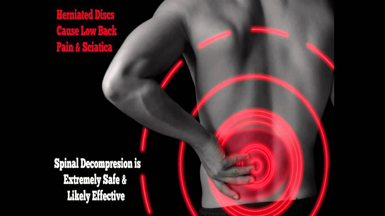 Acute Lumbar Herniated Disc Most Common Cause of Sciatica  Austin