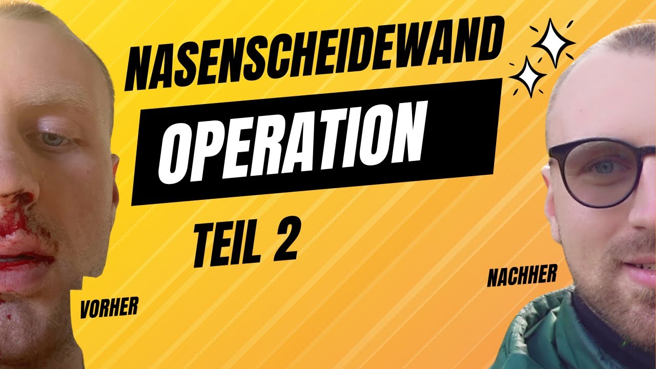 Nasenscheidewand OP Erfahrung | Nase | Septumplastik | 2 Woche |