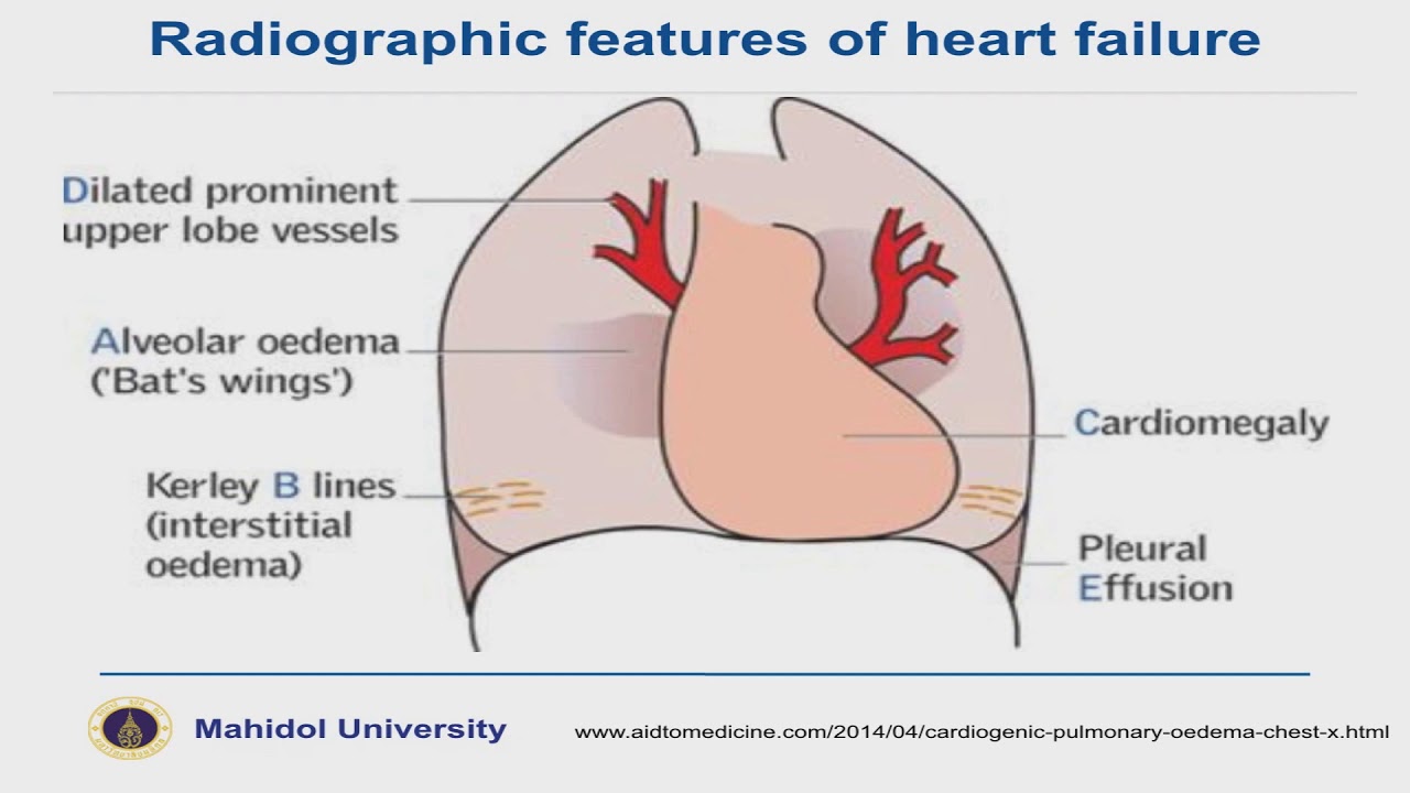 Acute Heart Failure for medical students Part 1