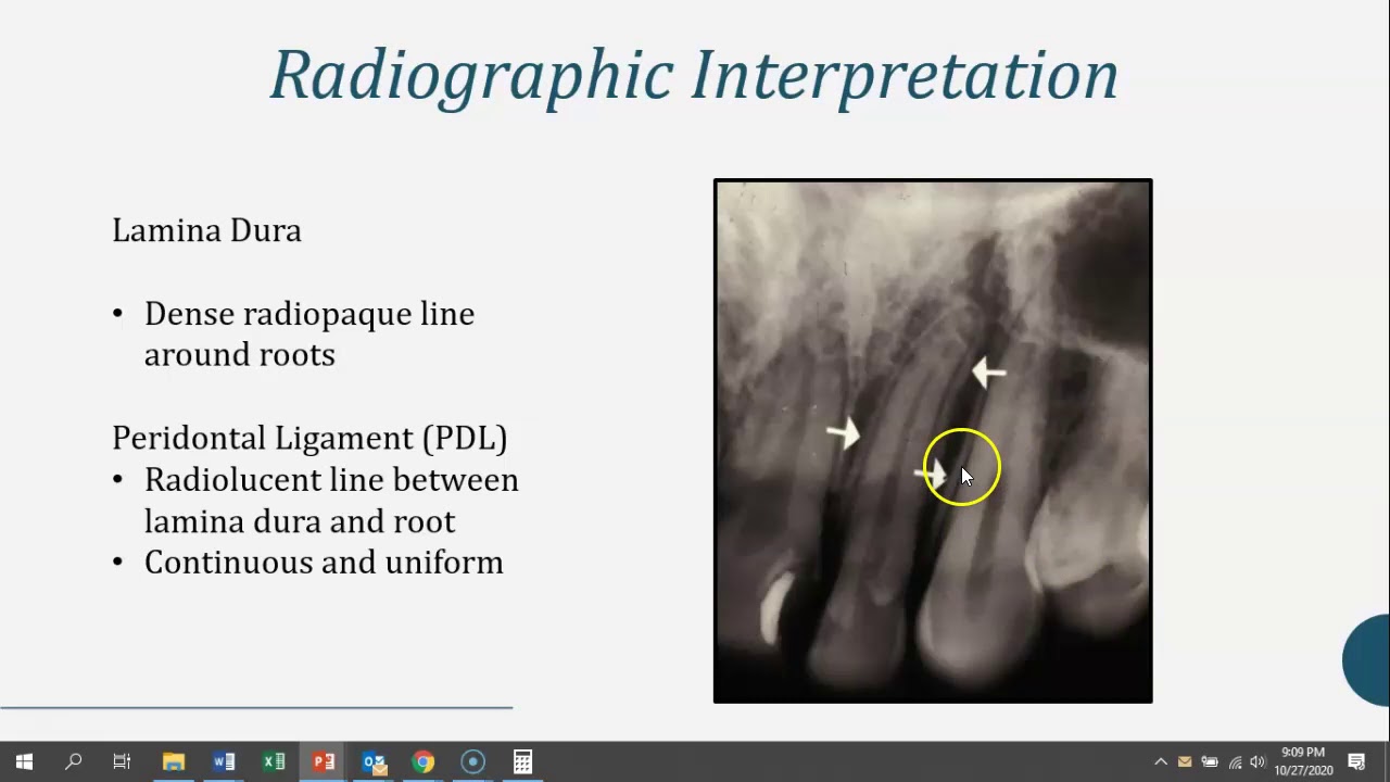 Periodontal Disease