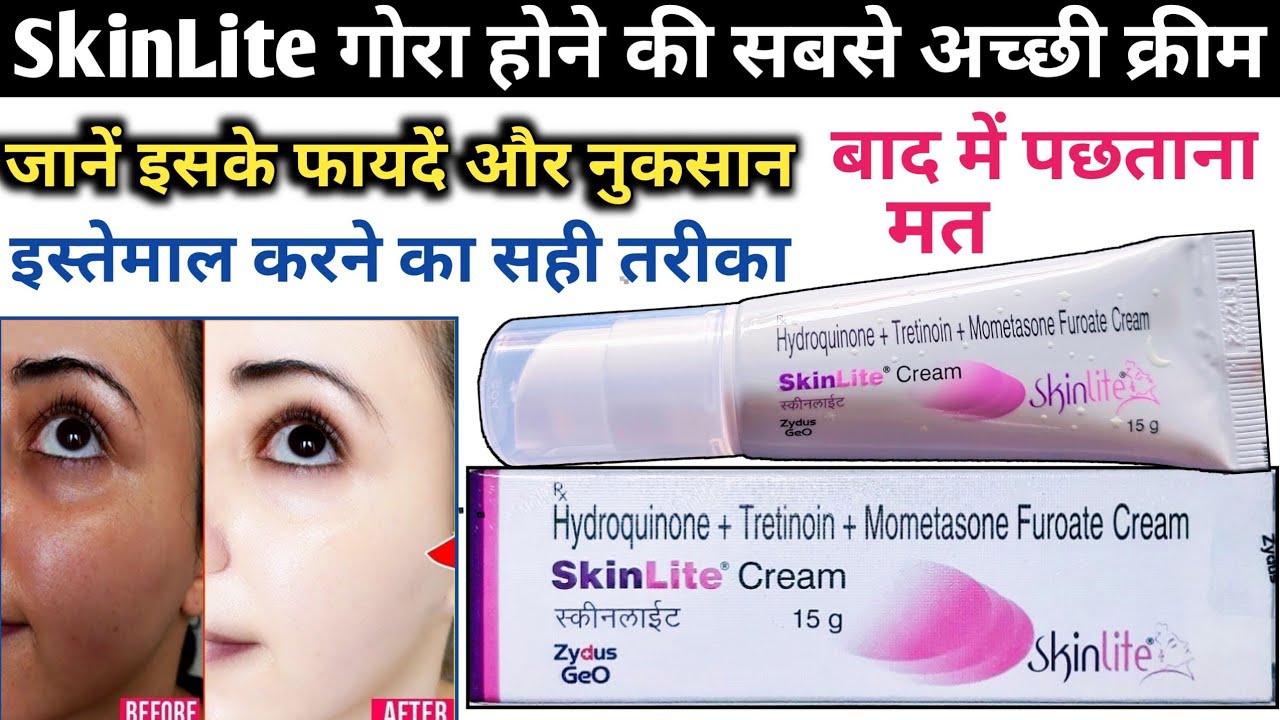 SkinLite cream | skinlite cream review in hindi | गोरेपन की क्रीम | fairness cream | skin lite cream