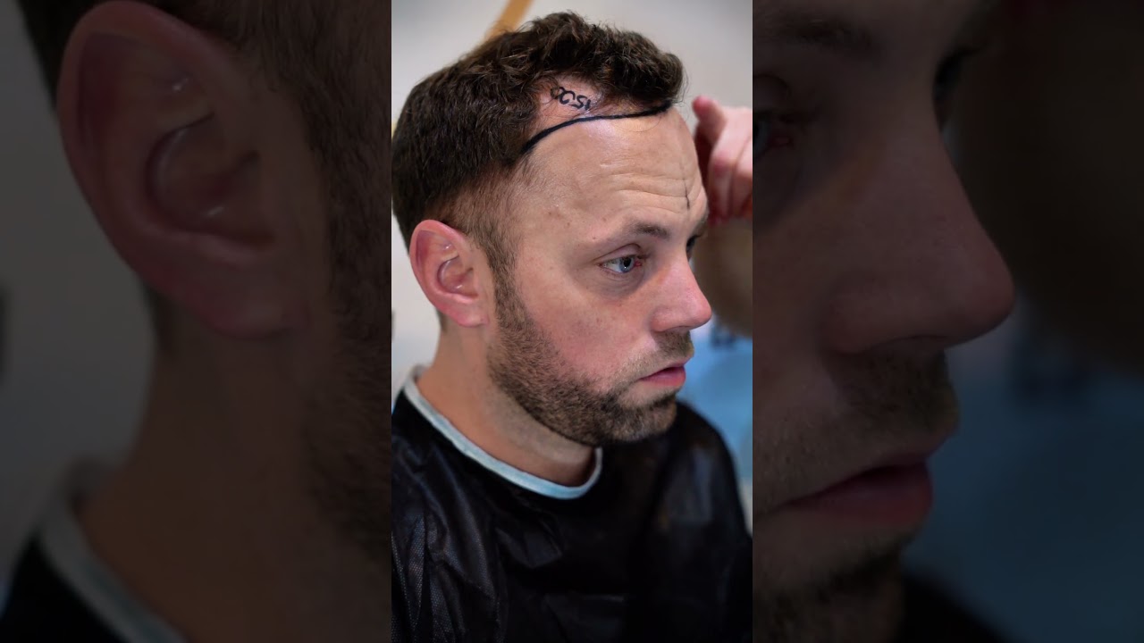 Client&rsquo;s Hair Transformation in Turkey | Istanbul Care Hair Transplant Process