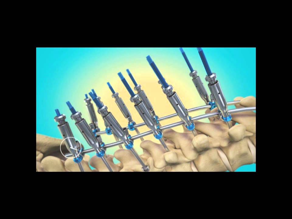 Kyphosis - Surgical Correction with Instrumentation