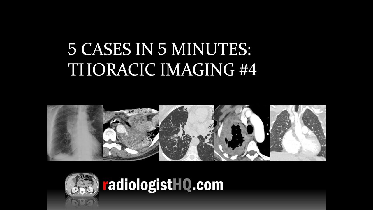 5 Cases in 5 Minutes: Thoracic #4