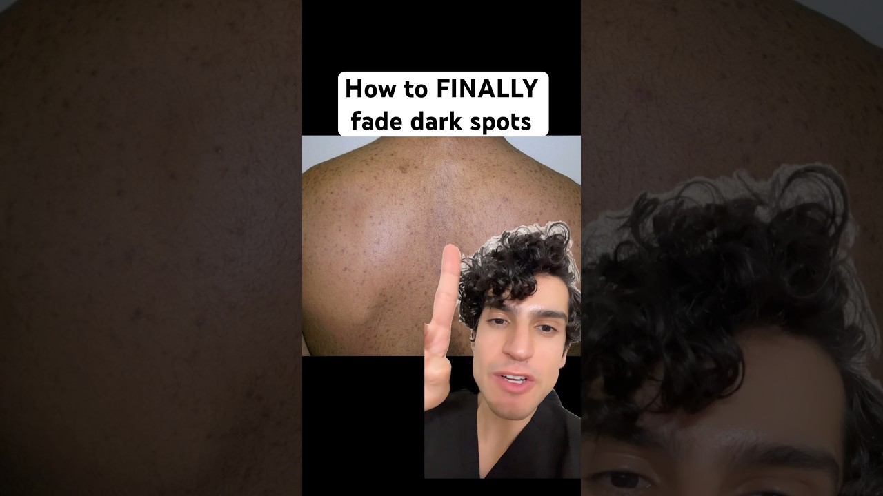 Derm reveals how to really treat dark spots on your back from acne #bacne #acnetreatment #darkspots