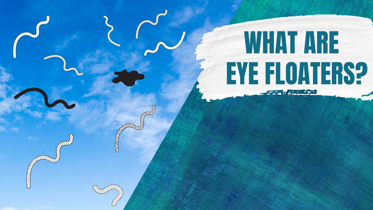What are eye floaters?
