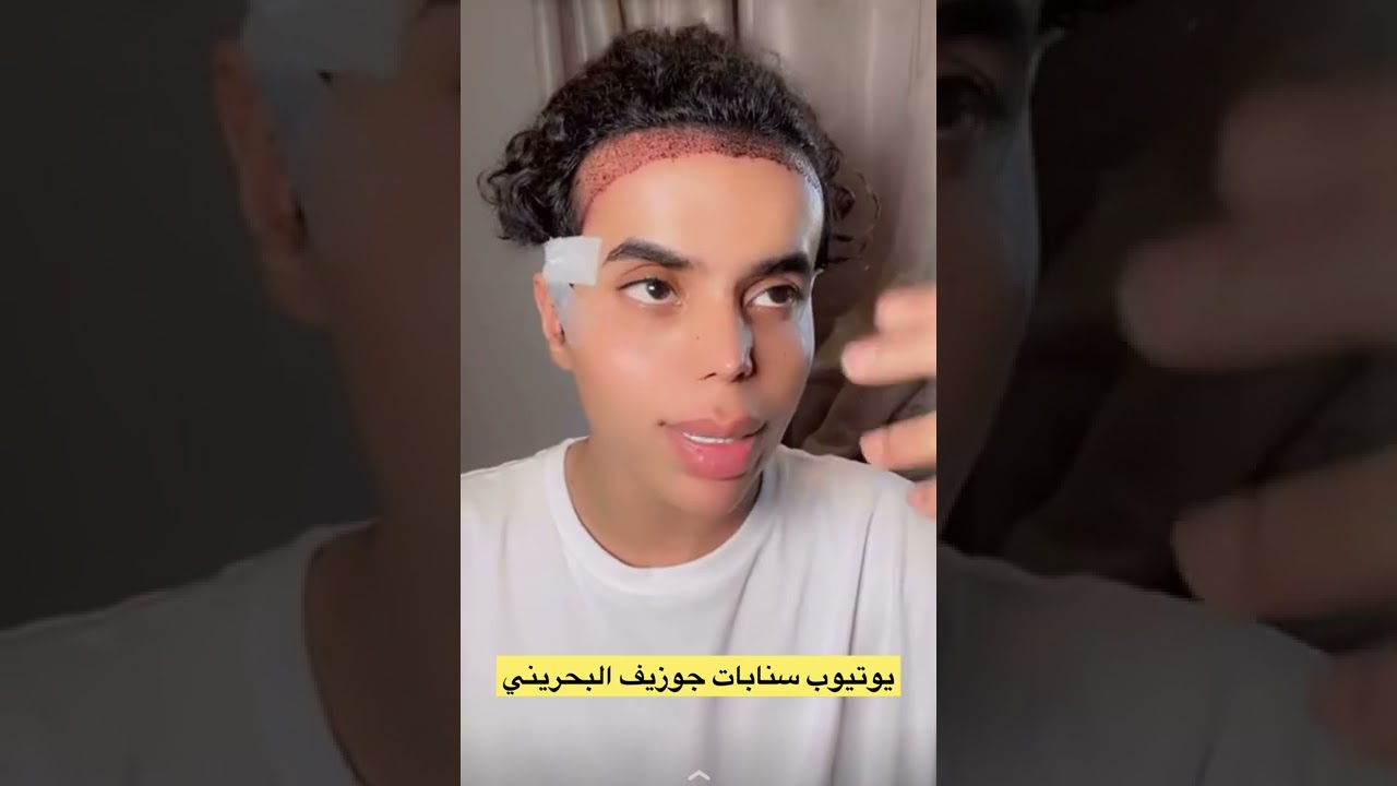 اول يوم لجوزيف بعد زراعه الشعر😍/ ٥٣٧ سنابات جوزيف البحريني