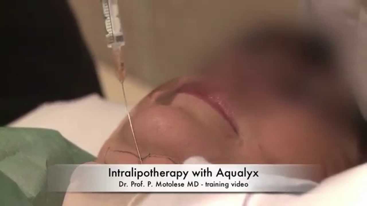 AQUALYX™ - Doppelkinn entfernen ohne Fettabsaugen