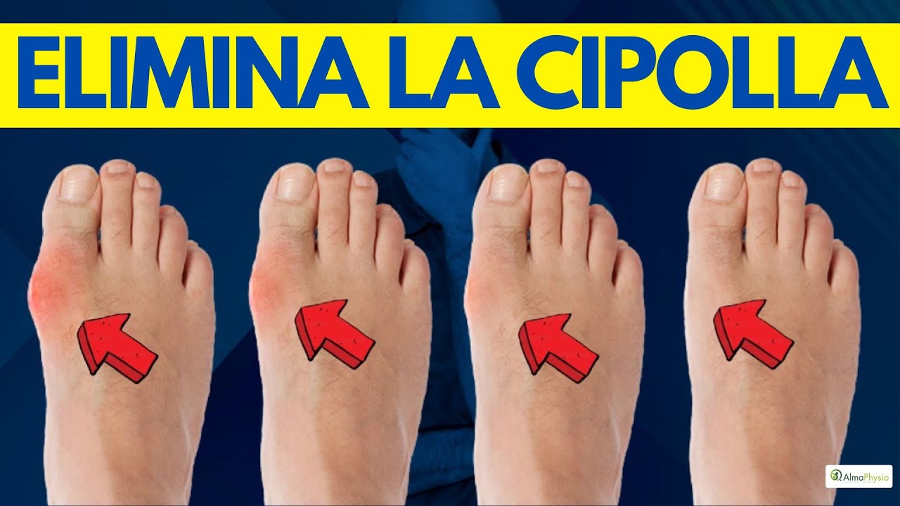 ALLUCE VALGO: 4 esercizi per ELIMINARE la CIPOLLA
