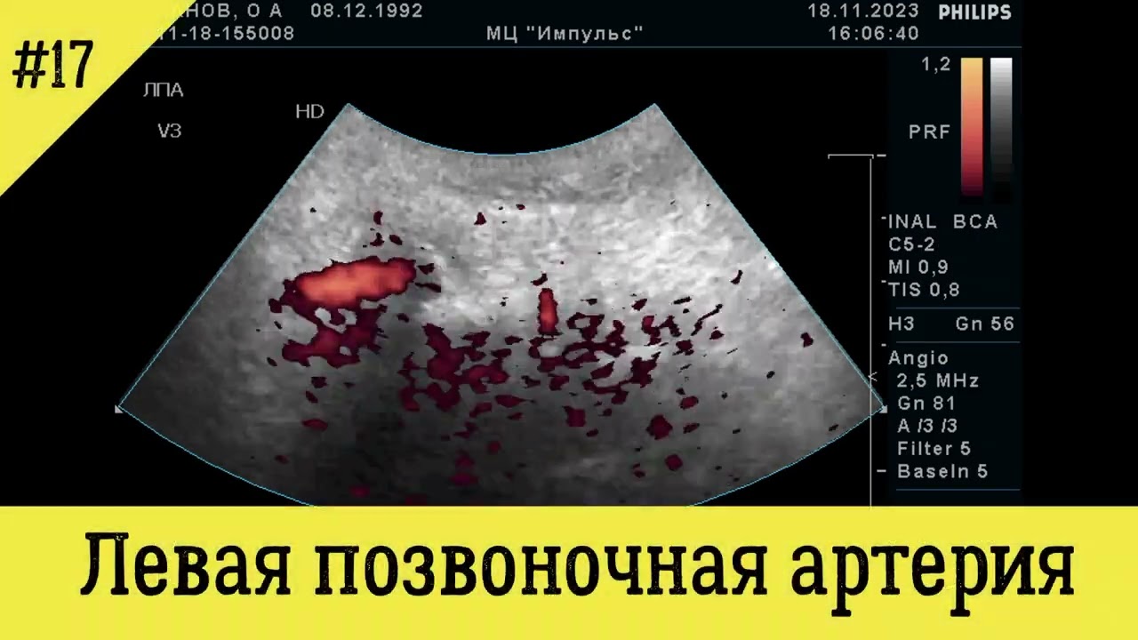 УЗИ БЦА. Септальный стеноз позвоночных артерий более 50%