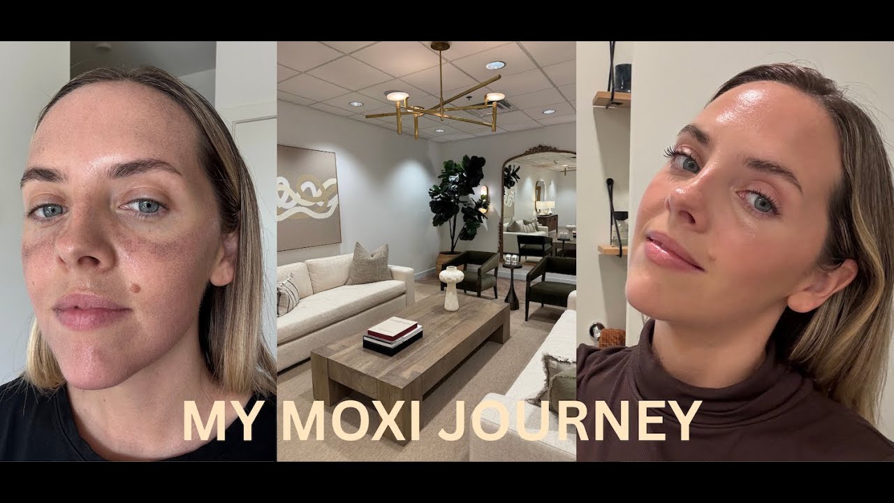 Лазер MOXI для лечения мелазмы | До и после лечения — все, что вам нужно знать!