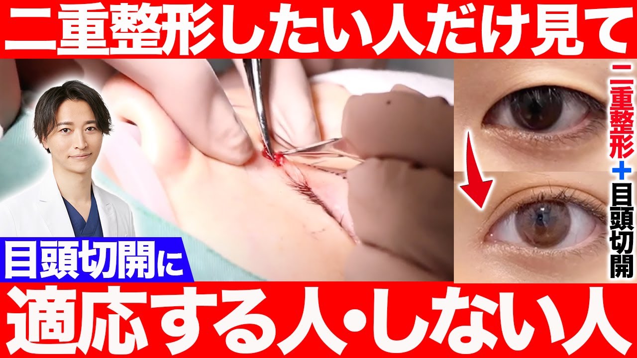 二重整形と一緒に受けるべき！目頭切開に適応する人・しない人