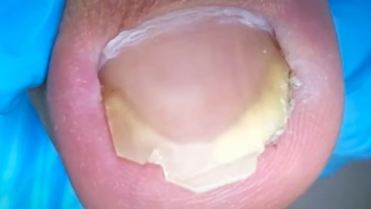 There Is Cotton Stuffed Under The Ingrown Toenail, Cut It Off Deeply!【Crazy pedicure room】