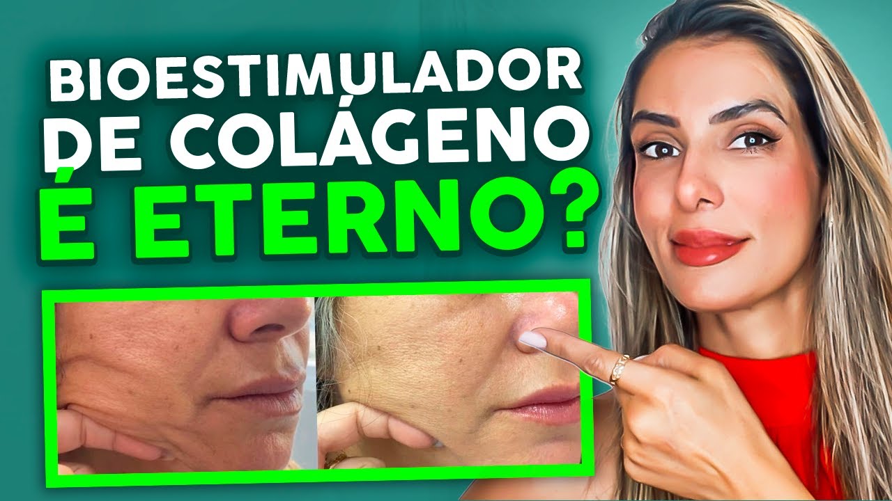 Quanto Tempo DURA o BIOESTIMULADOR de Colágeno?