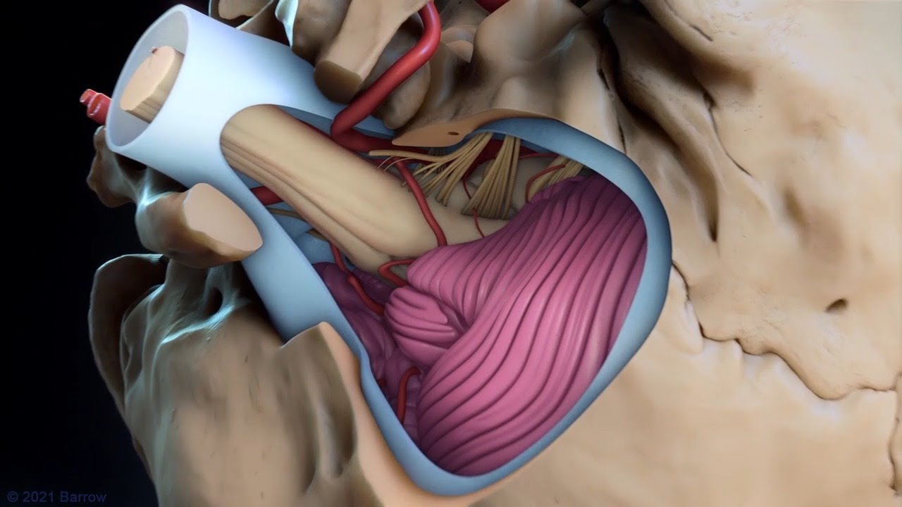 Far Lateral Approach for Macrovascular Decompression and Transposition of the Vertebral Artery