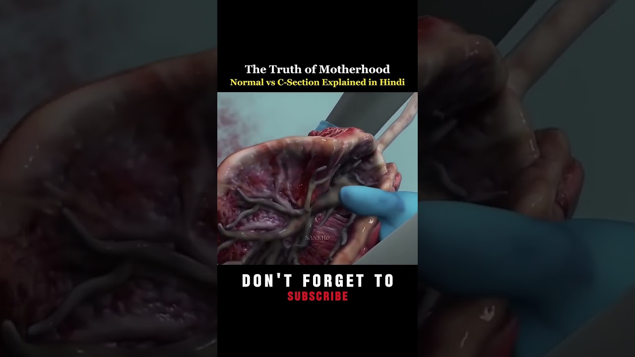 Normal Delivery or cesarean section which one are painful @AimAiimsNursing @Oeum-Ing-OBG #norcet