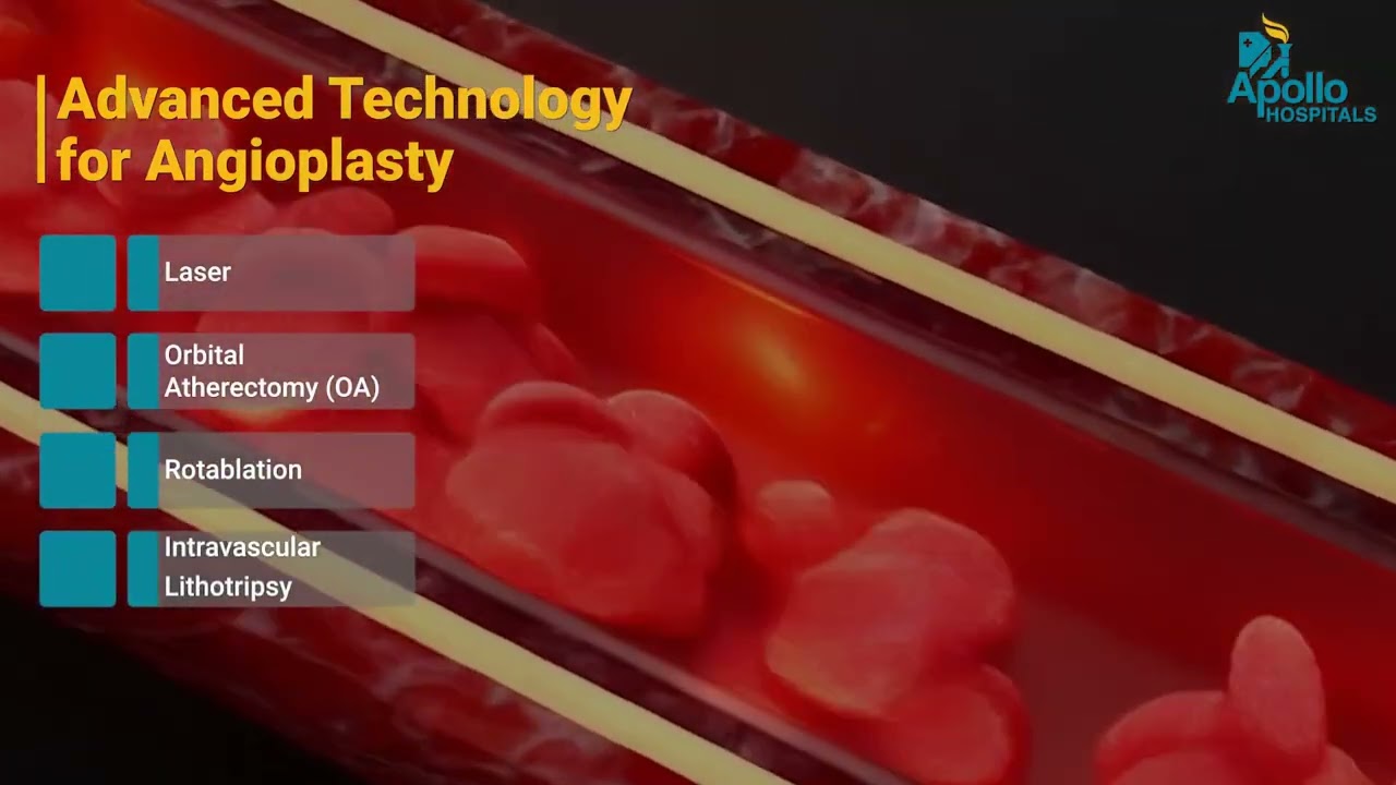 Angioplasty vs Bypass Surgery | Which Is Right for You?