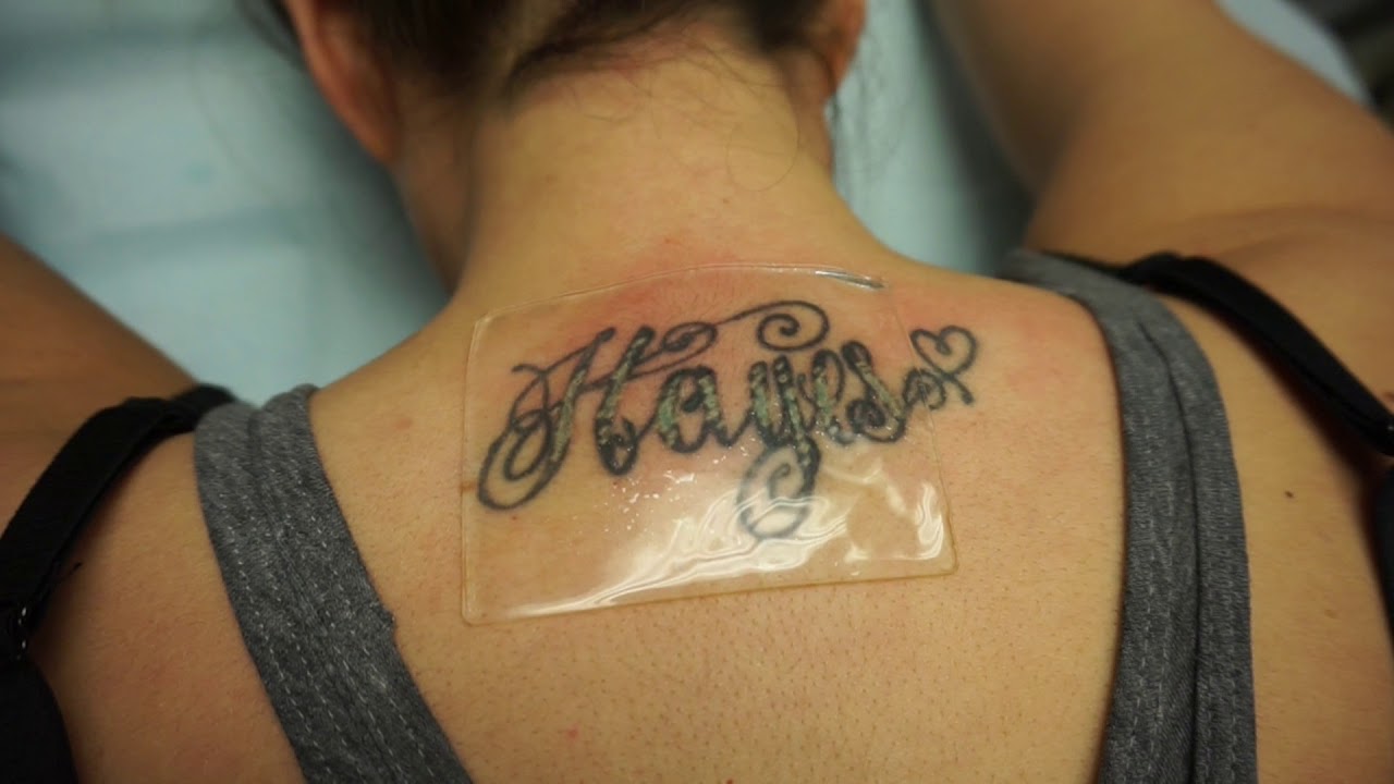 Squid (PFD) Patch Laser Tattoo Removal at South Coast MedSpa