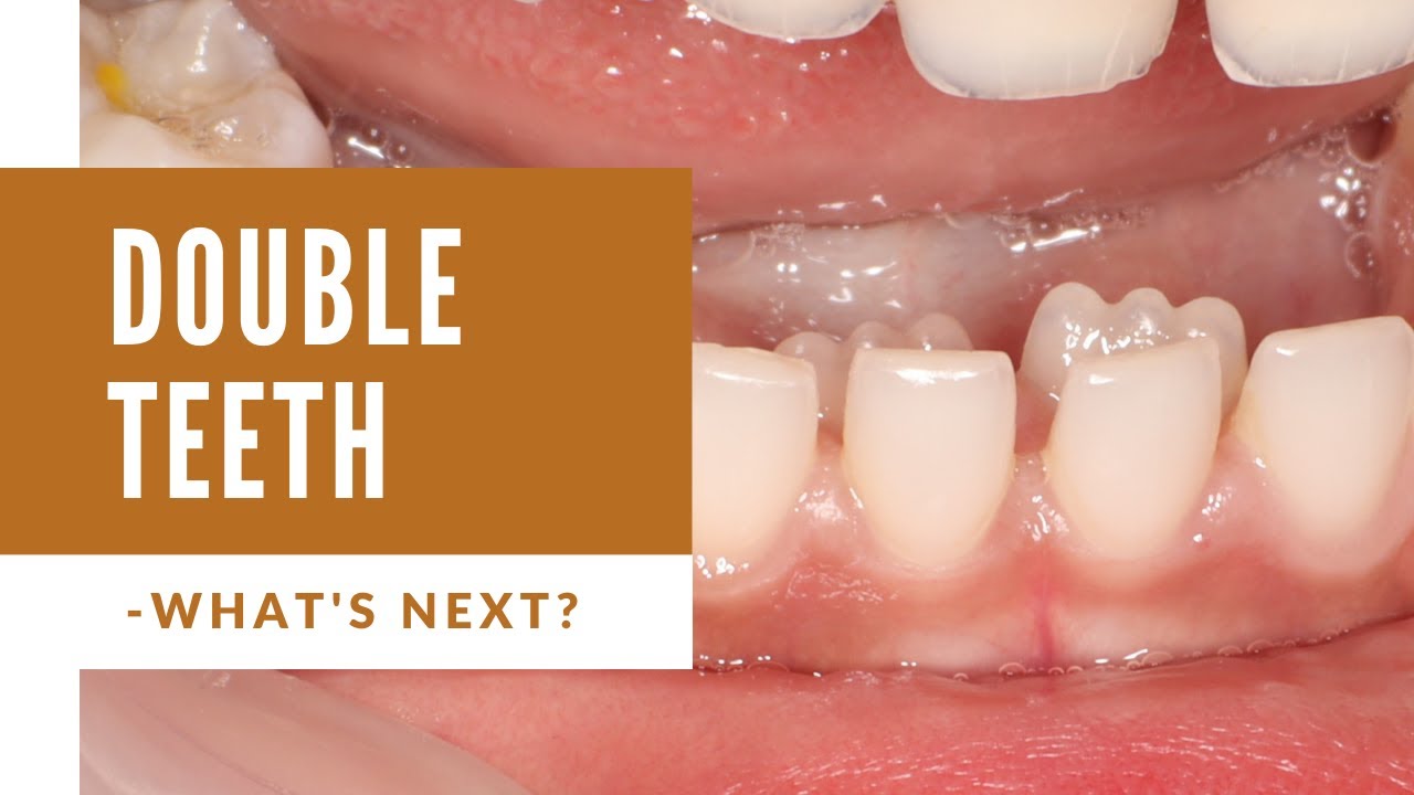 Kid with TWO ROWS of (Shark) Teeth -  What to do?