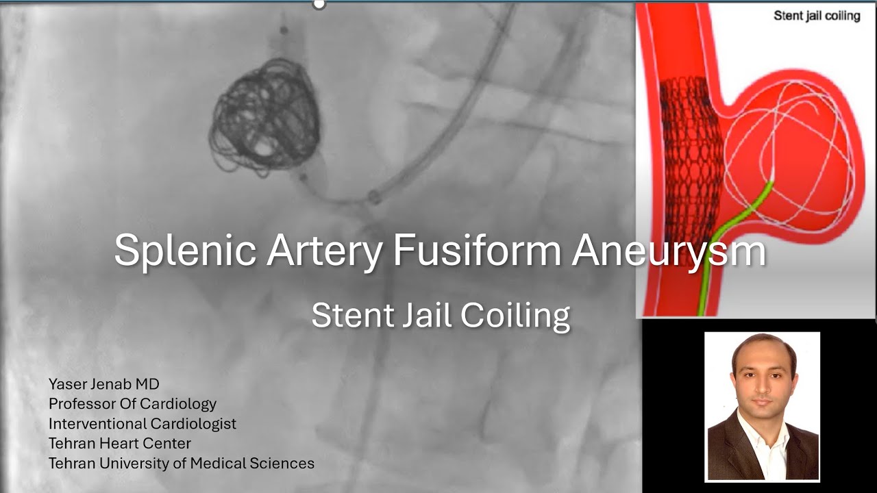 Splenic artery aneurysm: stent jail coiling
