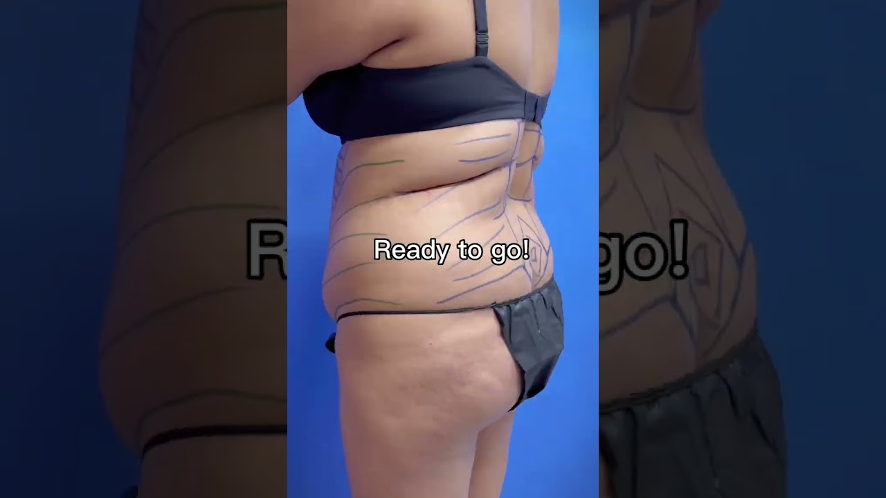 360 Liposuction | Dr. Erez Dayan | Avance Plastic Surgery