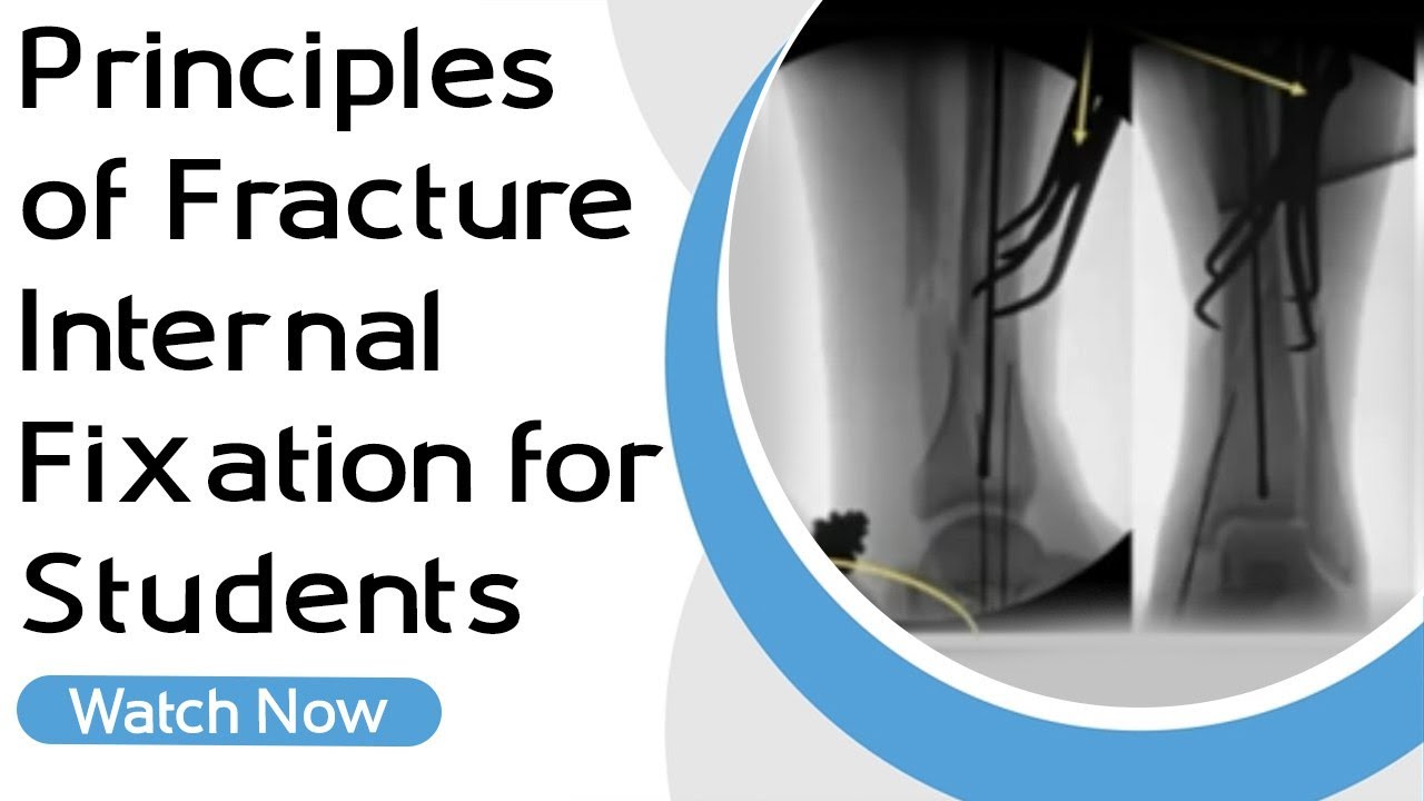 Principles of Fracture Internal Fixation for Students | Orthopaedic Academy