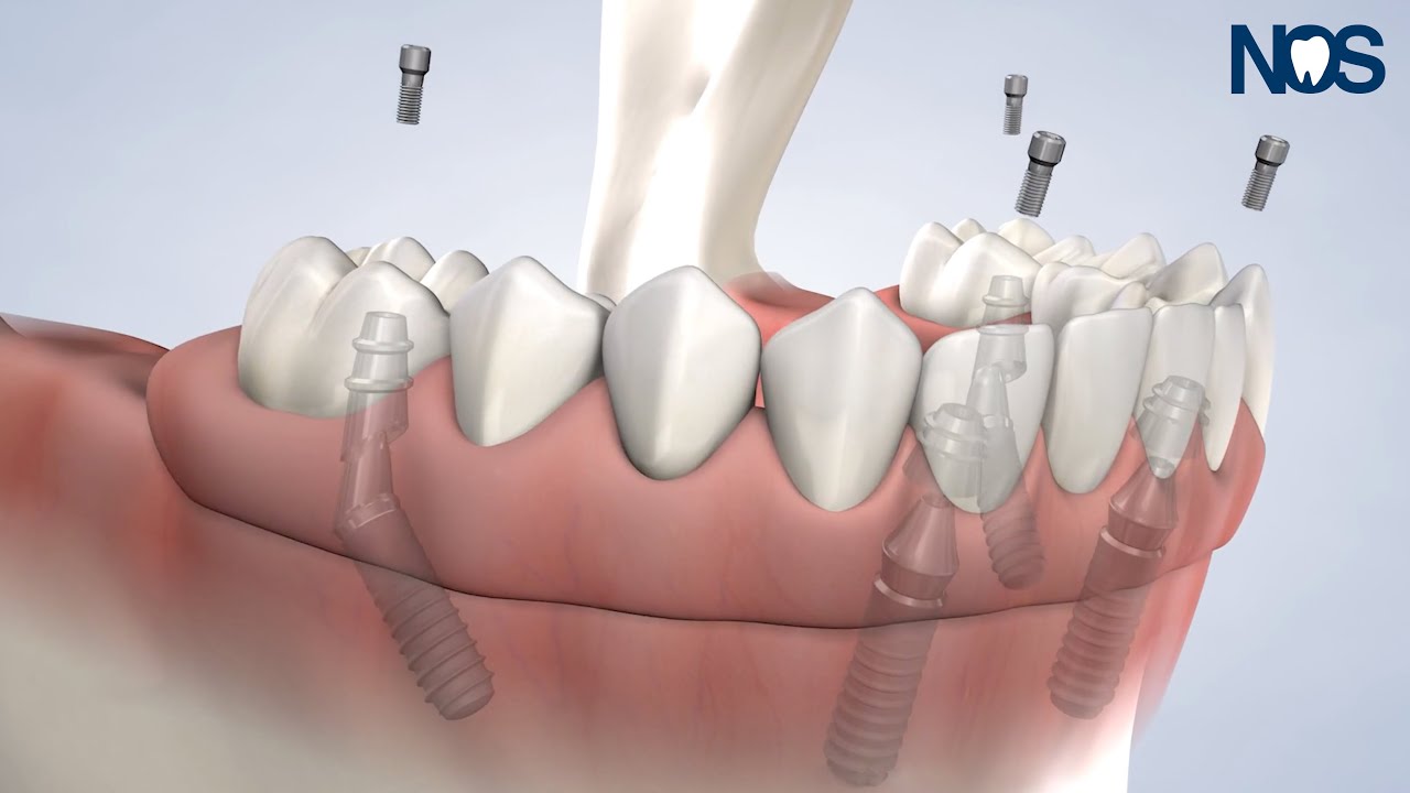 All-on-4&reg; Treatment Concept at Naperville Oral Surgery & Dental Implants
