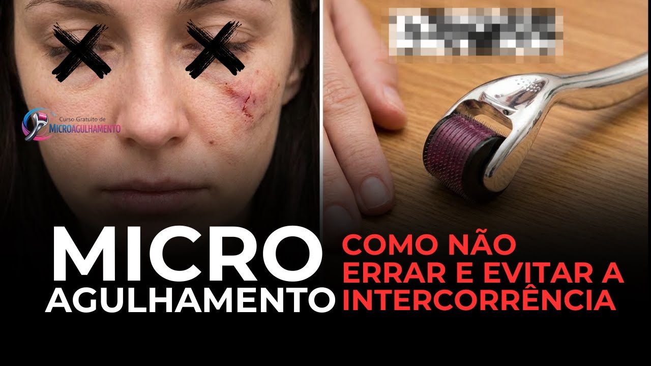 Como evitar as intercorrências do Microagulhamento