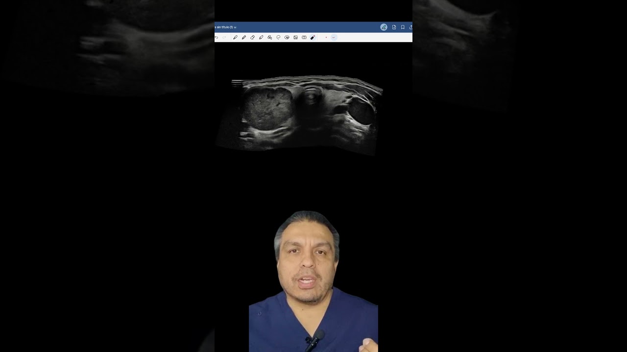 ACR TIRADS #tiroides #ultrasound #ense&ntilde;anza #learning #ultrasonido #ecografia #masterclass #docencia