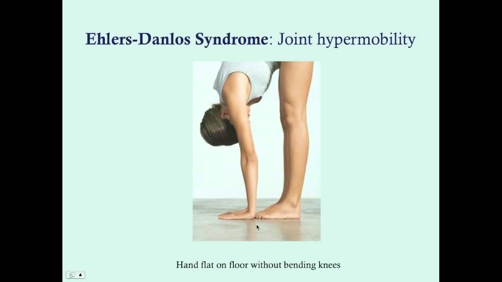Ehlers-Danlos Syndrome - CRASH! Medical Review Series