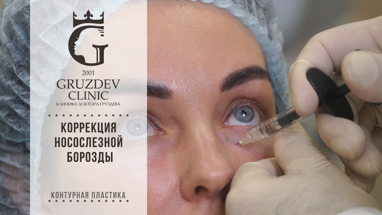 Коррекция носослезной борозды