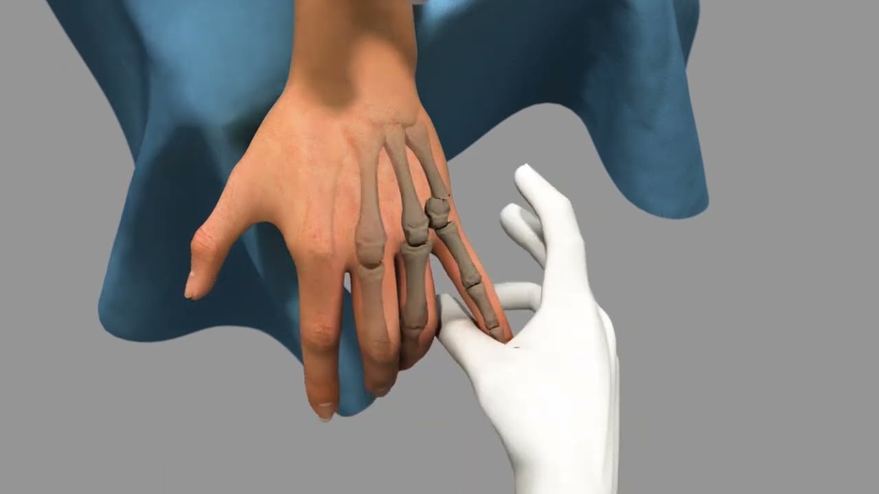 Boxer's Fracture  K-wire fixation| Boxer's Fracture| Fifth Metacarpal Neck Fractures