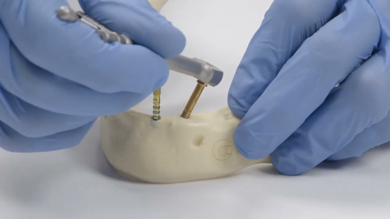 How to - Hands on using Angled Mini Conical Abutments